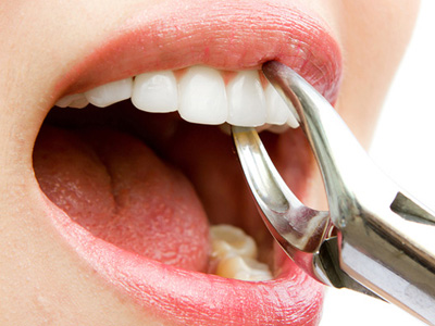 tooth extraction northridge